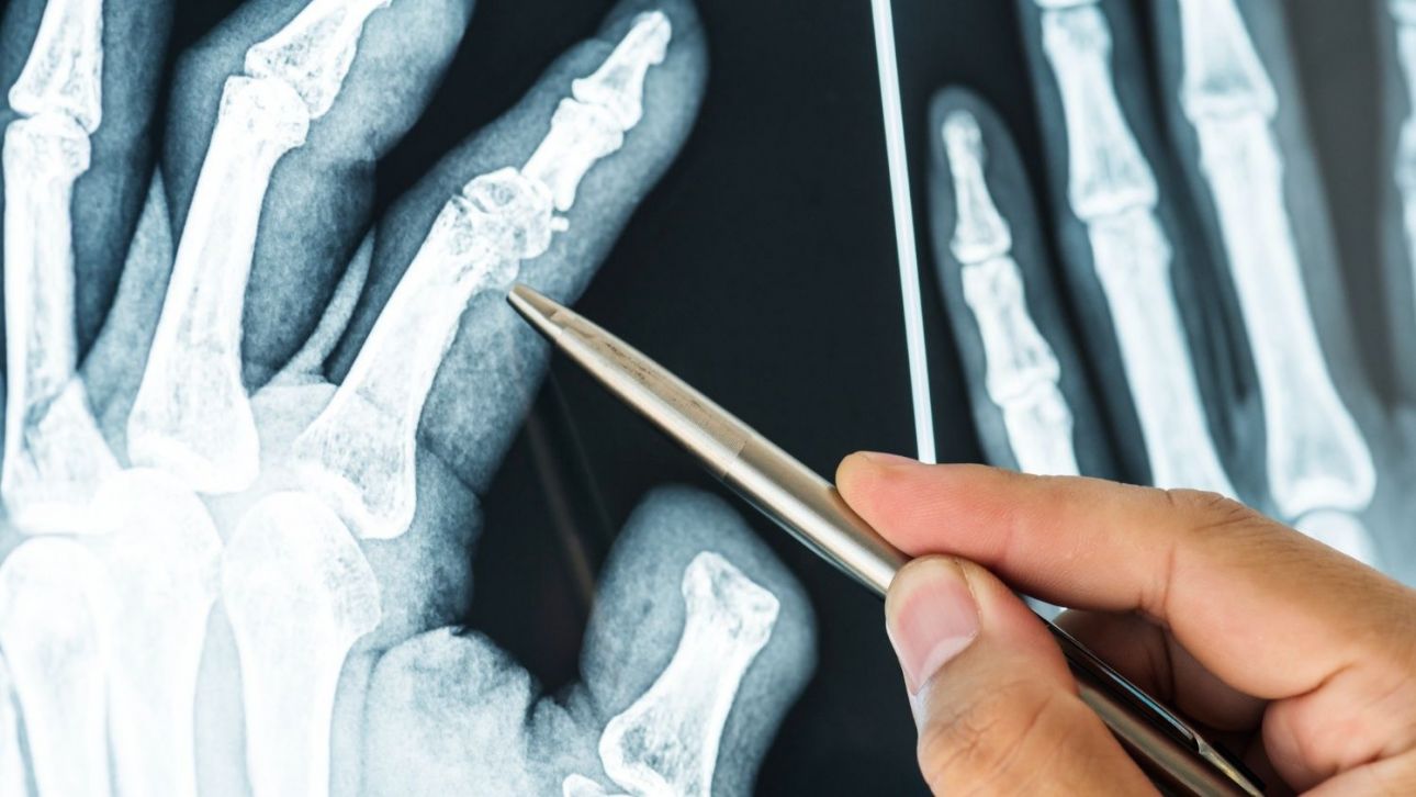 Ακόμη και βαθιά μέσα σε ανθρώπινα κόκαλα βρέθηκαν μικροπλαστικά