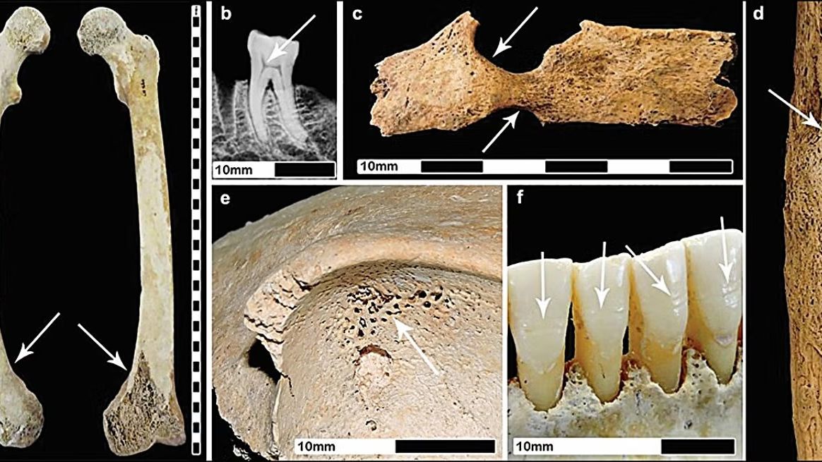 Οι αρχαίοι Ρωμαίοι έκαναν... κακό στην υγεία των Βρετανών - Τι αποκαλύπτει νέα μελέτη