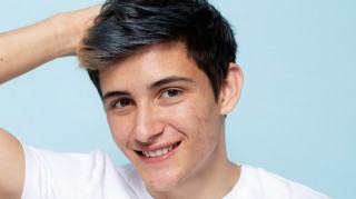 Η ακμή στην προεφηβεία και ο ρόλος του βάρους του παιδιού