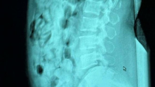 Μπέργκαμο: Συνελήφθη 46χρονη που είχε καταπιεί 120 αμπούλες ηρωίνης