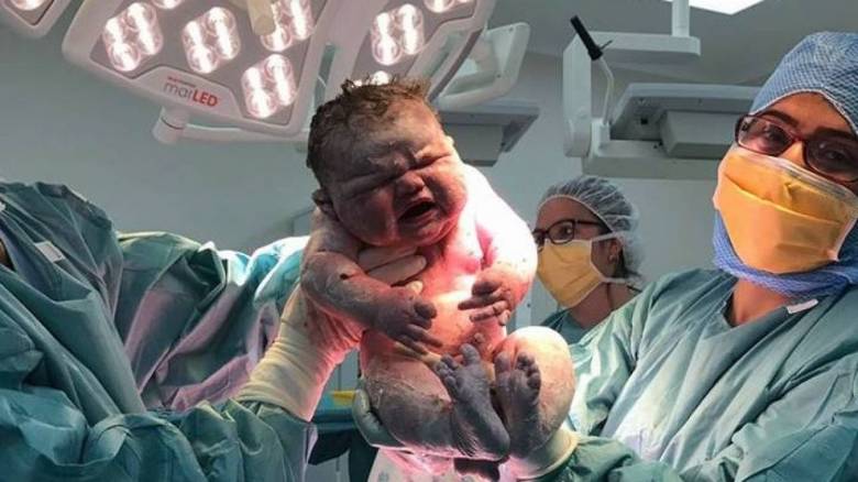 Το μωρό που γεννήθηκε 6 κιλά και έτρεχαν να δουν όλες οι νοσοκόμες (Pic)