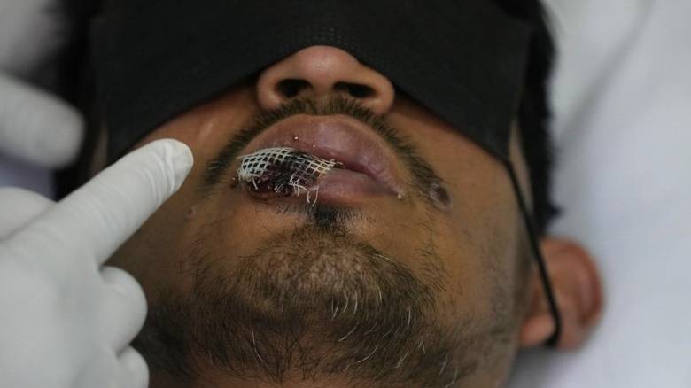 Ευλογιά των πιθήκων: Μπορεί να προκαλέσει και σοβαρές νευρολογικές και ψυχιατρικές επιπλοκές