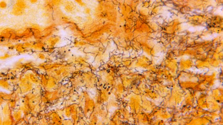 Ρεκόρ καταγράφουν τα σεξουαλικώς μεταδιδόμενα νοσήματα στην Ευρώπη - «Θερίζουν» σύφιλη και γονόρροια