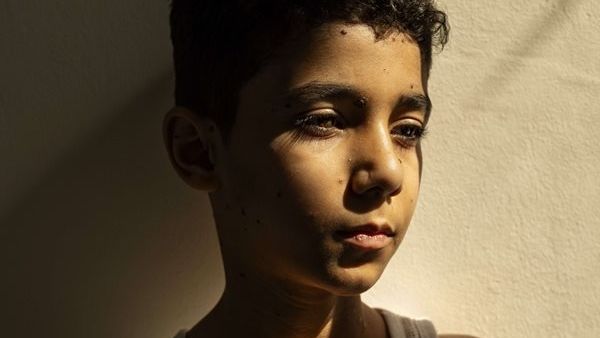 World Press Photo 2025: Πρώτο βραβείο σε φωτογραφία 9χρονου Παλαιστίνιου που ακρωτηριάστηκε στη Γάζα