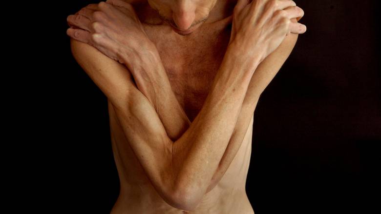 Στατιστικά που πονάνε, σιωπές που σκοτώνουν: Ο αγώνας κόντρα στις διατροφικές διαταραχές