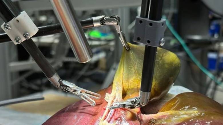 Ρομπότ πραγματοποίησε για πρώτη φορά χειρουργική επέμβαση χωρίς ανθρώπινη βοήθεια