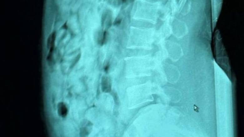 Μπέργκαμο: Συνελήφθη 46χρονη που είχε καταπιεί 120 αμπούλες ηρωίνης