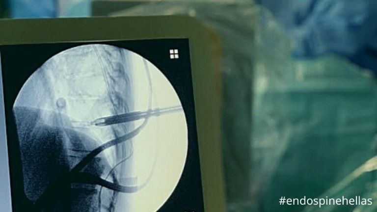 Πρωτοποριακές Ενδοσκοπικές & Ελάχιστα Επεμβατικές Τεχνικές (MISS) για παθήσεις Σπονδυλικής Στήλης