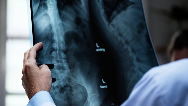 Αρθροπλαστική ισχίου με τομή bikini και ρομποτικό σύστημα ROSA