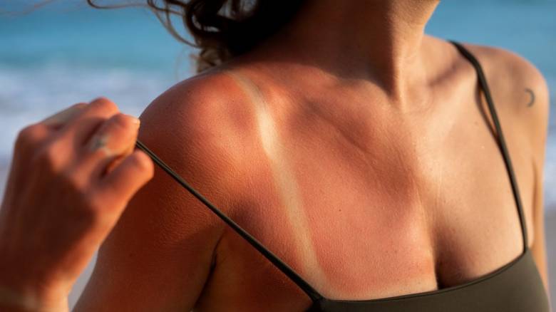 Μόλις ένα άσχημο κάψιμο από τον ήλιο αρκεί για να αλλάξει την υγεία μας για πάντα, σύμφωνα με μελέτη