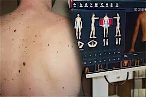 Ξέρεις πώς ανιχνεύεται ο καρκίνος του δέρματος;