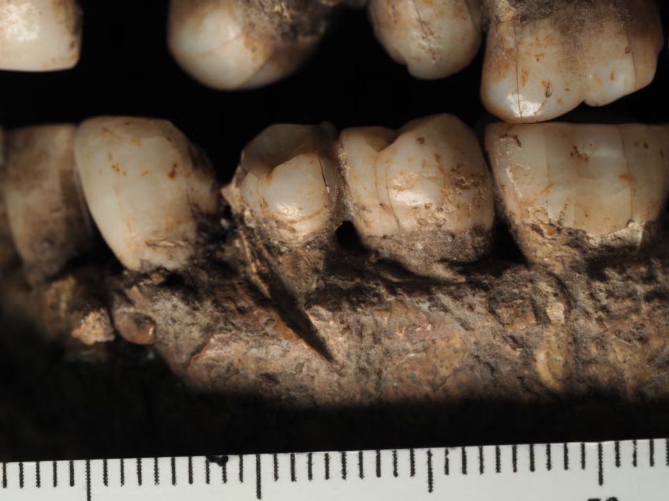 stab-mark-on-mandible.jpg