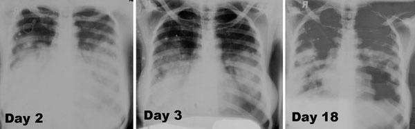 pneumonic-plague-xray.jpg